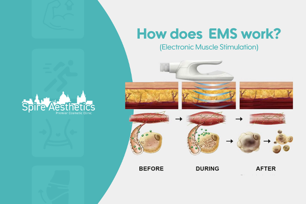 EMS treatment for post pregnancy weight loss treatment Scottish