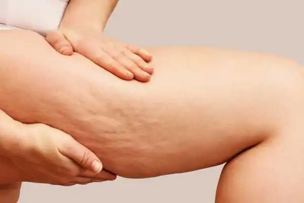 Image of woman showing leg with cellulite Scottish