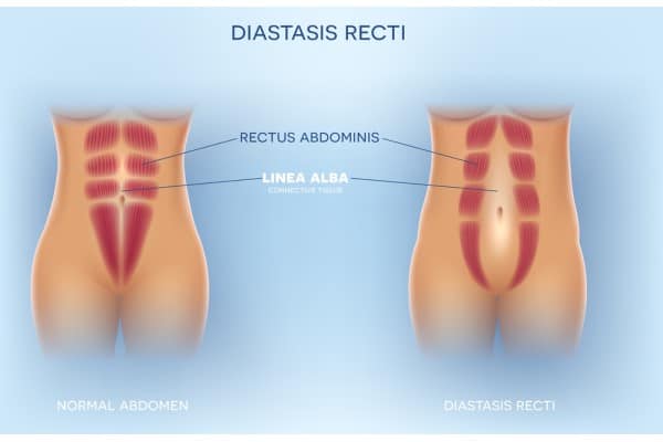 What Non-Surgical Options Are Available for Diastasis Recti Scottish?