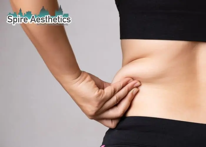 Image of woman pinching fat on their hips Scottish. Fat Freezing treatment