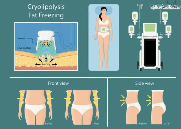 Fat freezing treatment Scottish benefits for competitions to remove stubborn fat deposits.