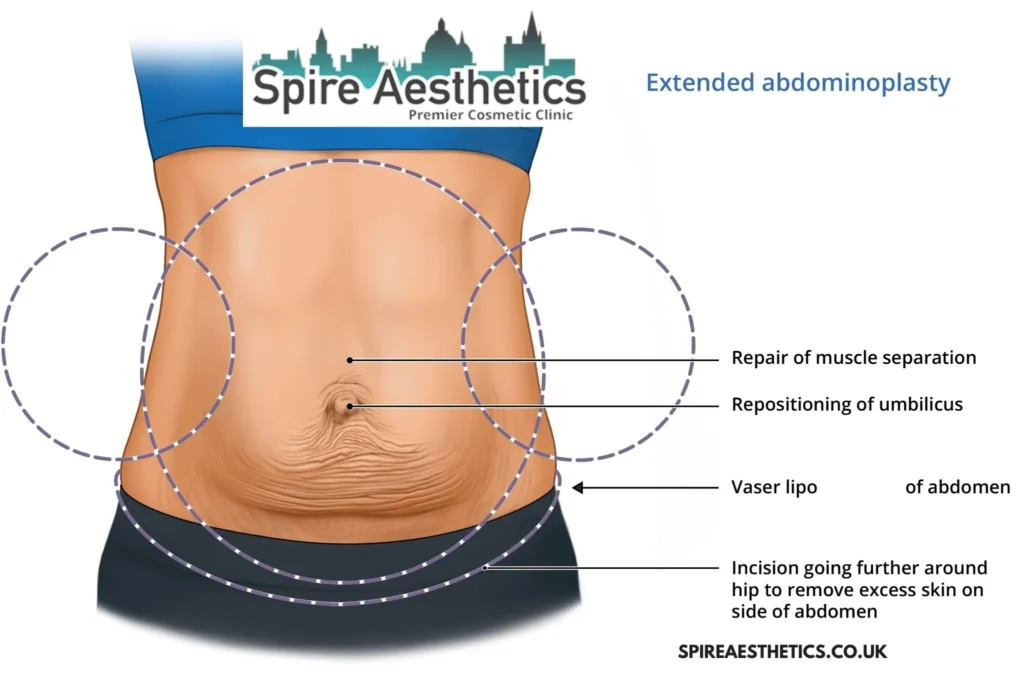 Understanding Loose Skin After Gastric Band Scottish Surgery and HIFU Treatment