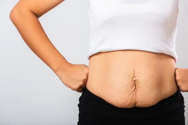Image of a woman's stomach after weight loss with sagging skin following a gastric band Scottish