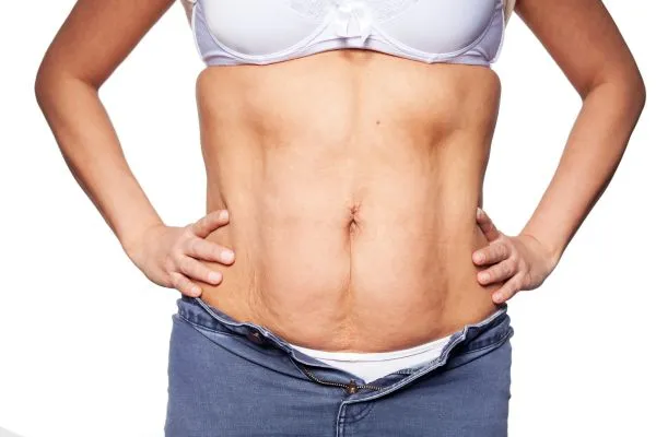 sagging skin on woman's stomach after weight loss injections Scottish