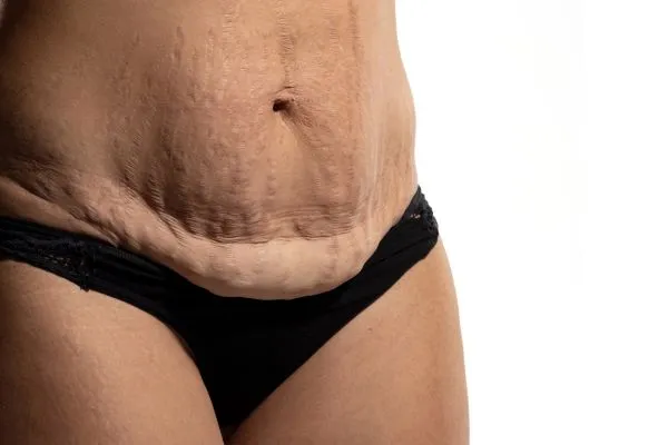 Image of womans stomach after weight loss injections Scottish showing saggy skin