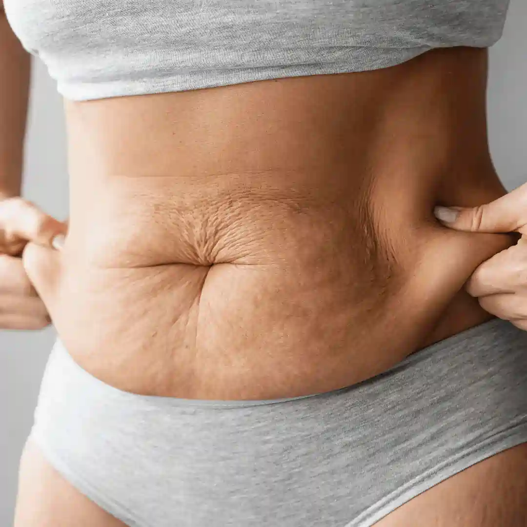 Is It Normal to Have Loose Skin After Pregnancy Scottish?