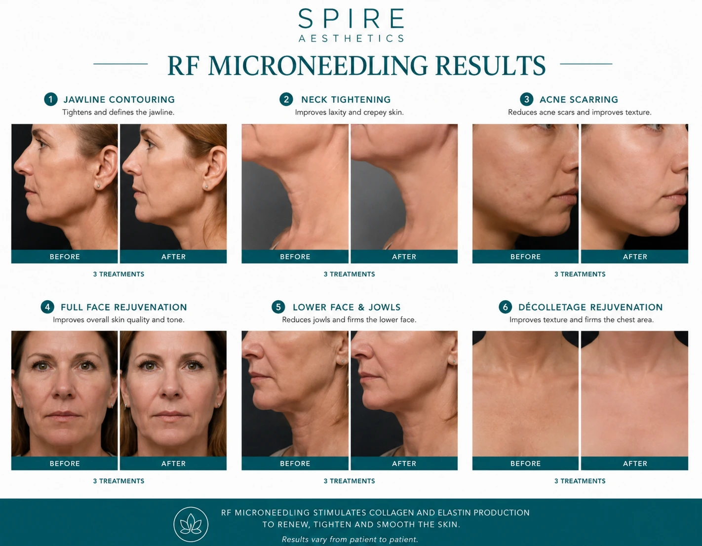 RF Microneedling Skin tightening Scottish results