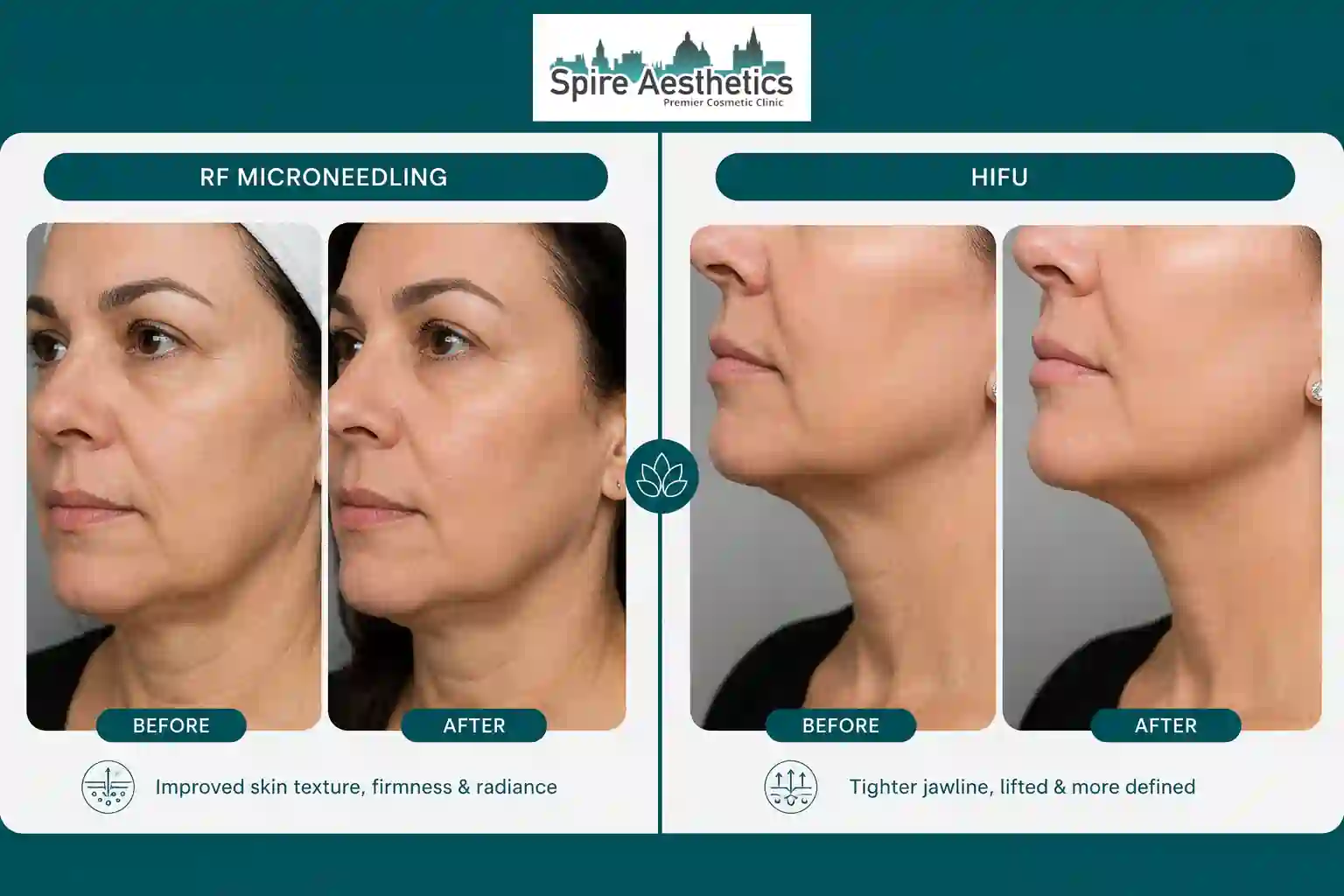 Can RF Microneedling and HIFU Be Combined Scottish?