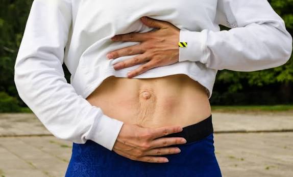 When Could Diastasis Recti Be the Missing Piece of the Puzzle Scottish?