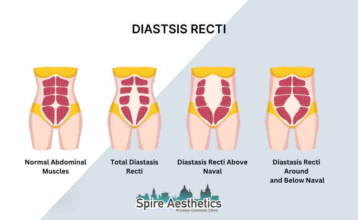 Is Non-Surgical Diastasis Recti Treatment Right for You? Common Concerns Answered Scottish